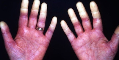 Hội chứng Raynaud