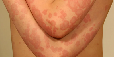 Hồng ban đa dạng (erythema multiforme)