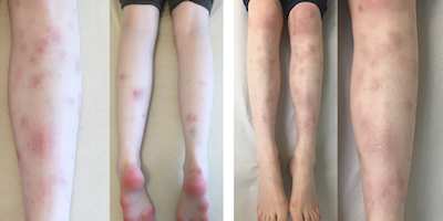 Hồng ban nút (erythema nodosum)