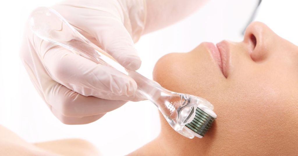 Cách lăn kim trị sẹo rỗ có tốt không? Liệu trình như thế nào?