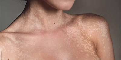 Bệnh lang ben là gì? Cách điều trị lang ben ra sao?