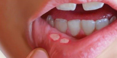 Loét miệng tái diễn (aphthous)