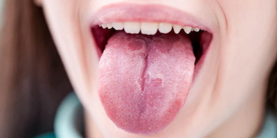 Lưỡi bản đồ (geographic tongue)