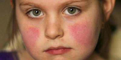 Những điều cần biết về lupus ban đỏ hệ thống ở trẻ em