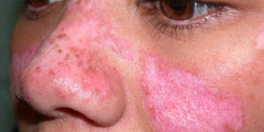 Lupus ban đỏ dạng đĩa (discoid lupus erythematosus)