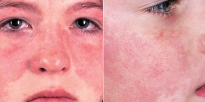 Bệnh Lupus ban đỏ