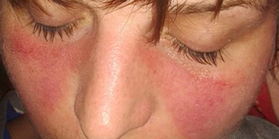 Lupus ban đỏ hệ thống (systemic lupus erythematosus)
