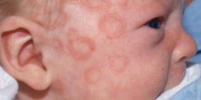 Bệnh Lupus ban đỏ sơ sinh: Những điều cần biết