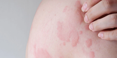 Bệnh mày đay (urticaria)