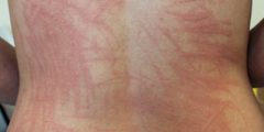 Mề đay vật lý (physical urticaria)
