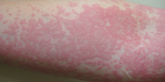 Mề đay ánh sáng (solar urticaria)