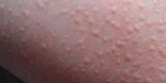 Bệnh mề đay nhiệt (cholinergic urticaria)