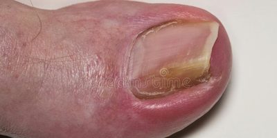 Móng chân mọc ngược (onychocryptosis)