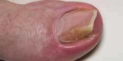 Móng chân mọc ngược (onychocryptosis)