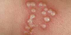 Mụn rộp sinh dục (genital herpes)