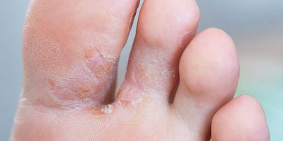 Nguyên nhân và cách xử lý nước ăn chân mùa mưa hiệu quả