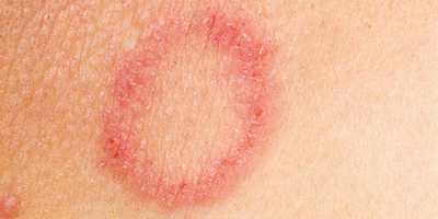 Một số bệnh nấm da thường gặp & cách điều trị, phòng bệnh