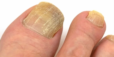 Bệnh nấm móng (onychomycosis)