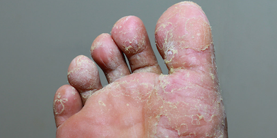 Bệnh nấm nông ở da (superficial fungal skin infections)