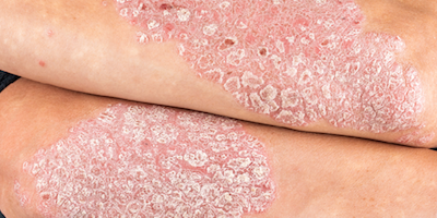 Các bệnh nấm sâu (deep fungal infections)