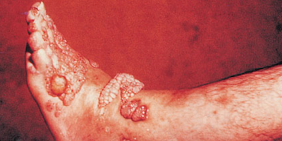 Nấm sâu chromomycois