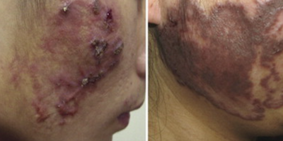 Nấm sâu phaeohyphomycois