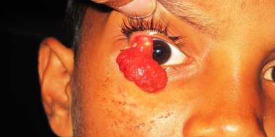 Nấm sâu rhinosporidiosis