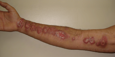 Nấm sâu sporotrichosis