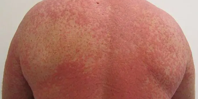 Nhiễm độc da dị ứng thuốc (drug eruption)