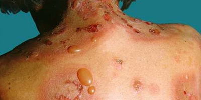 Bệnh Pemphigiod bọng nước