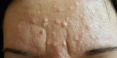 Quá sản tuyến bã (sebaceous hyperplasia)