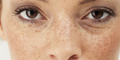 Rám má (chloasma)