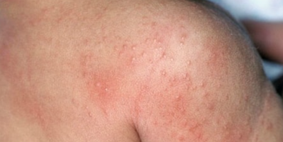 Rôm sảy (miliaria)