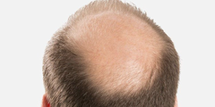 Rụng tóc do nội tiết tố nam (alopecia androgenetic)