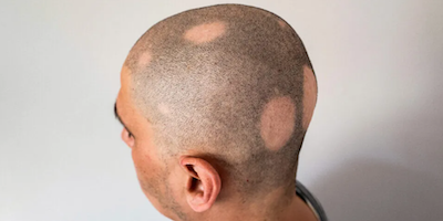 Rụng tóc vùng (alopecia areata)