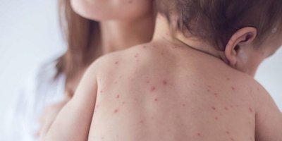 Sẩn ngứa ở trẻ em