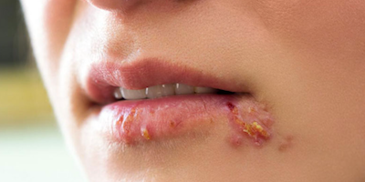 Herpes dễ nhầm lẫn với 4 bệnh ở đường sinh dục