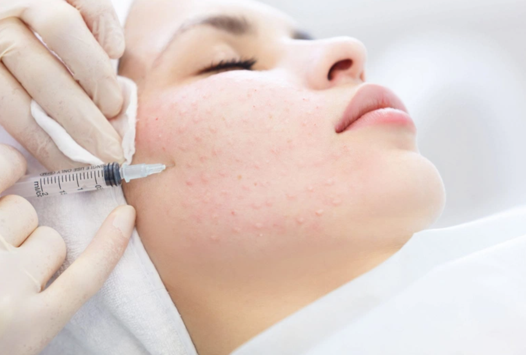 Tiêm meso căng bóng da mặt là gì? Tác dụng và lưu ý khi tiêm meso