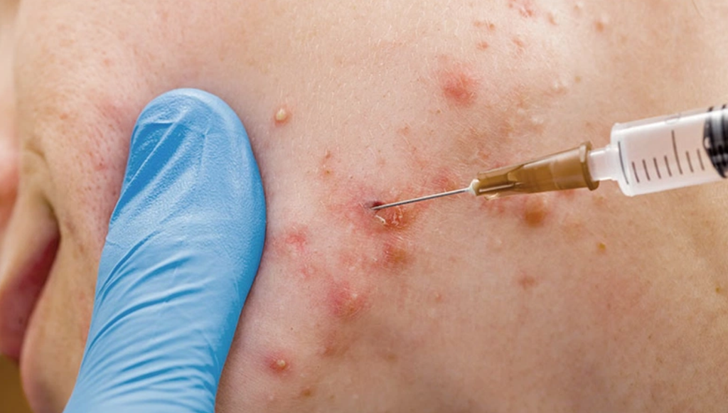 Bóc tách sẹo: Giải pháp hiệu quả điều trị sẹo rỗ, sẹo lõm