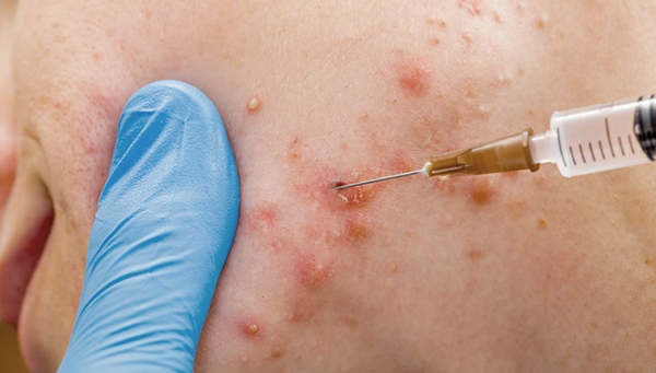 Bóc tách sẹo: Giải pháp hiệu quả điều trị sẹo rỗ, sẹo lõm