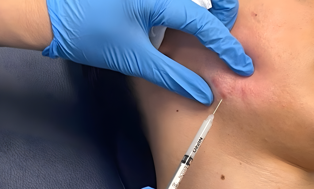 Tiêm Triamcinolone trị sẹo lồi có hiệu quả không? Ưu & nhược điểm?