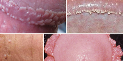 Bệnh sùi mào gà (genital warts, condyloma, condylomata acuminata)