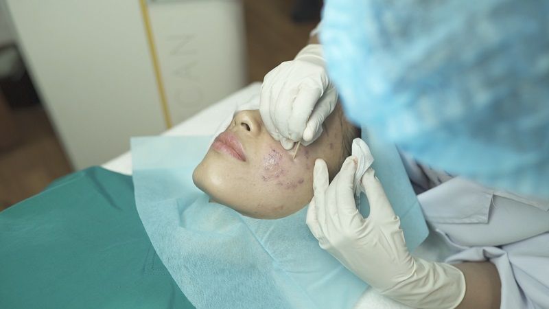 TCA là gì? Ứng dụng như thế nào trong điều trị thẩm mỹ da?