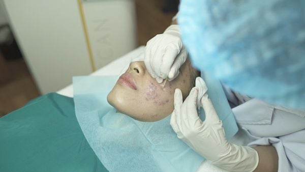 TCA là gì? Ứng dụng như thế nào trong điều trị thẩm mỹ da?