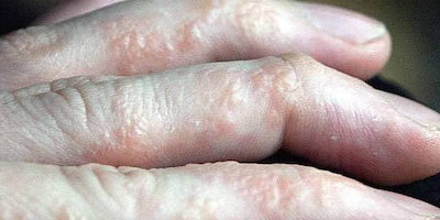 3. Triệu Chứng của Bệnh Eczema Tổ Đỉa