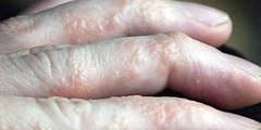 Tổ đỉa (dyshidrotic eczema, dyshidrotic dermatitis, pompholyx)