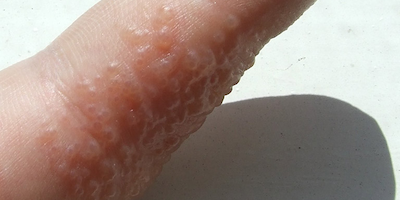 Bệnh tổ đỉa có nguy hiểm không? Chữa trị thế nào cho hiệu quả?