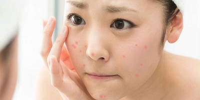 Điều trị mụn trứng cá ở tuổi teen