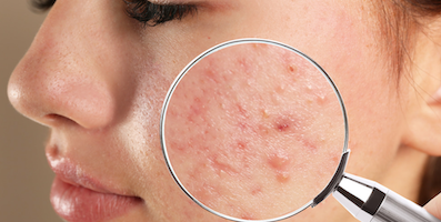Trứng cá (acne)