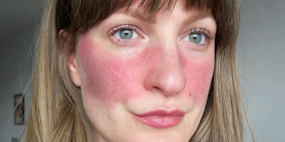 Trứng cá đỏ (rosacea, red skin rash)